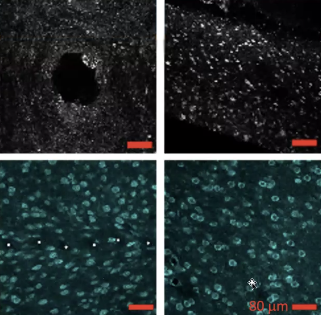 A grid of four images. The top two, in black and white, show the damage that the Utah array leaves as an approximately 100 micrometer hole in the brain. The bottom row, in teal, highlights the lack of damage from the carbon fiber wires used by the StiMote team.